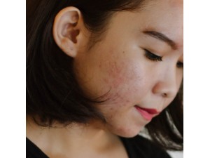 Natural Anti-acne Solution ACZERO
